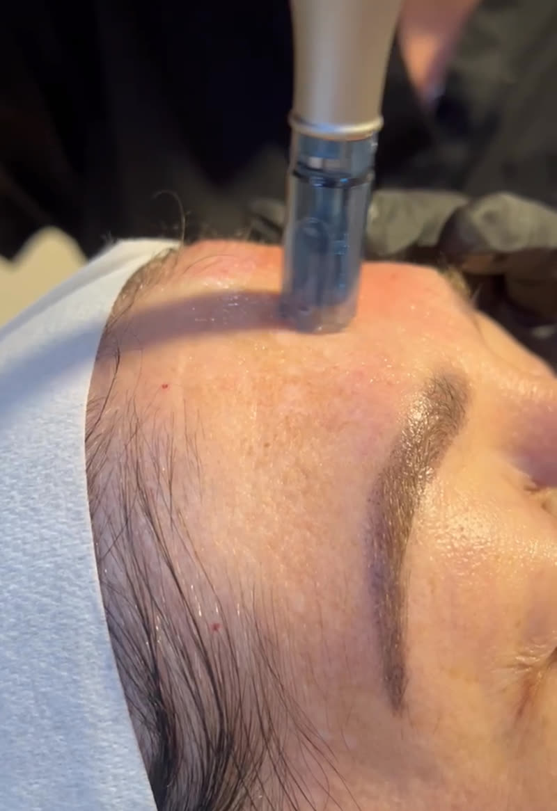 Microneedling treatment