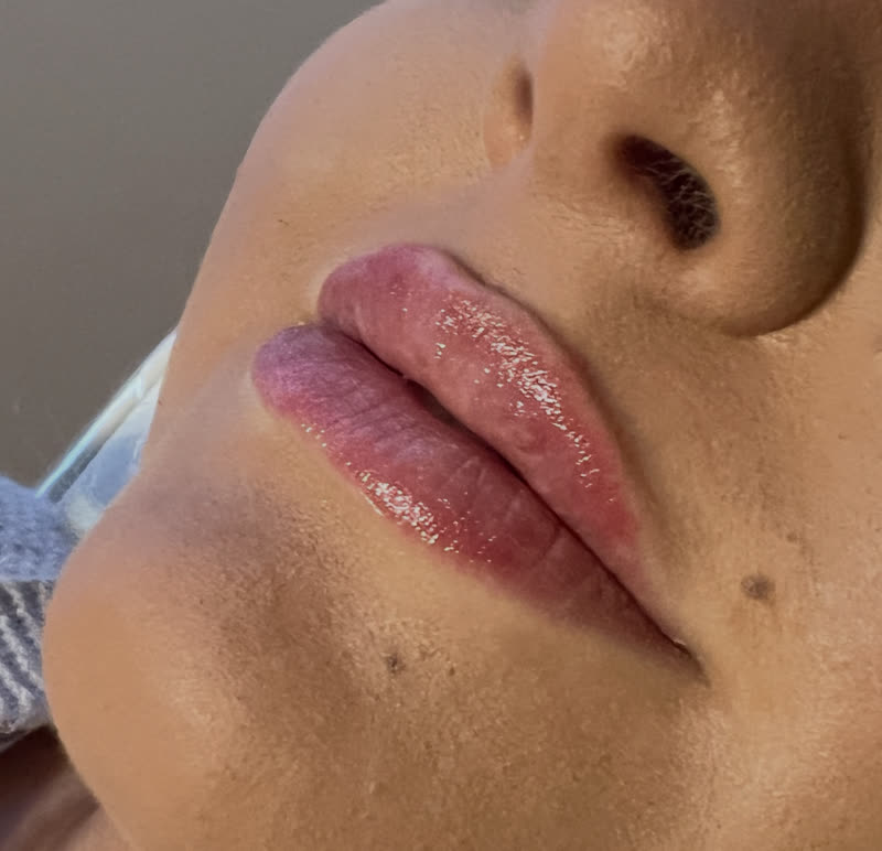 Dermal filler results