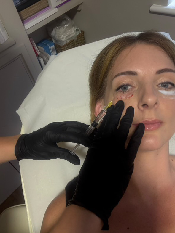 Skin booster treatment